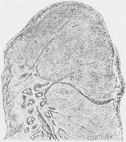 Illustration ur Läkarebok för alla : hälso- och sjukvårdslära i populär form (1893), sida 95