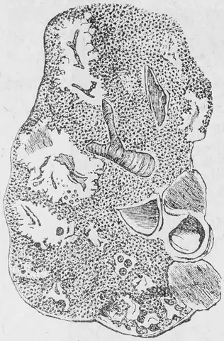 Illustration ur Läkarebok för alla : hälso- och sjukvårdslära i populär form (1893), sida 96
